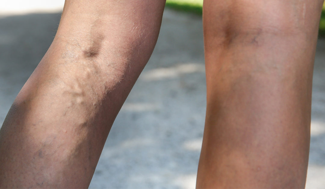 Varicose Veins
